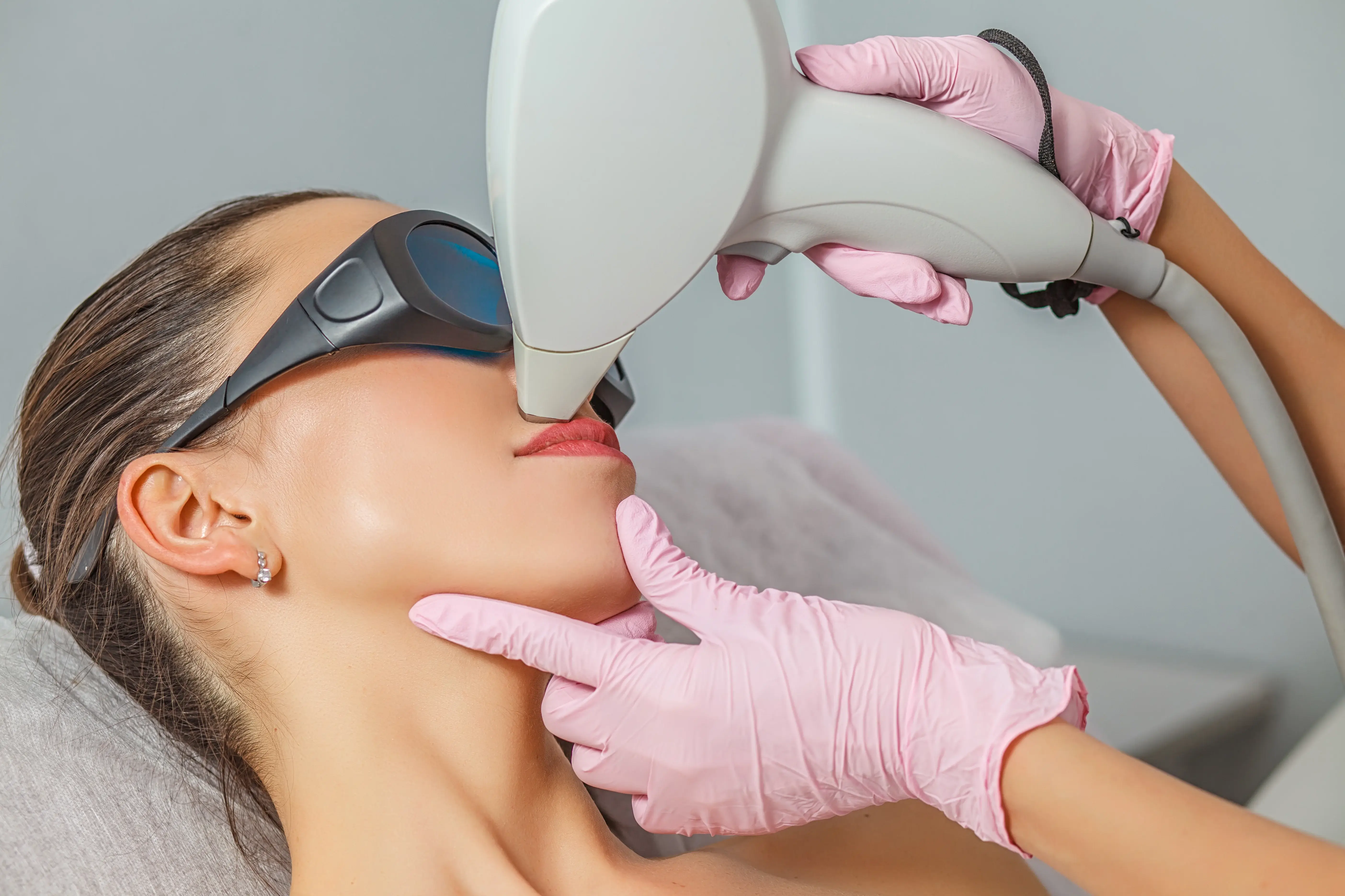 Épilation laser visage Alençon