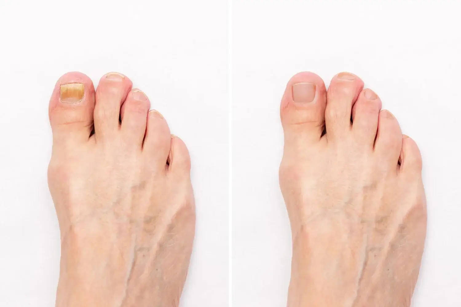 Traitement mycose ongles laser Alençon